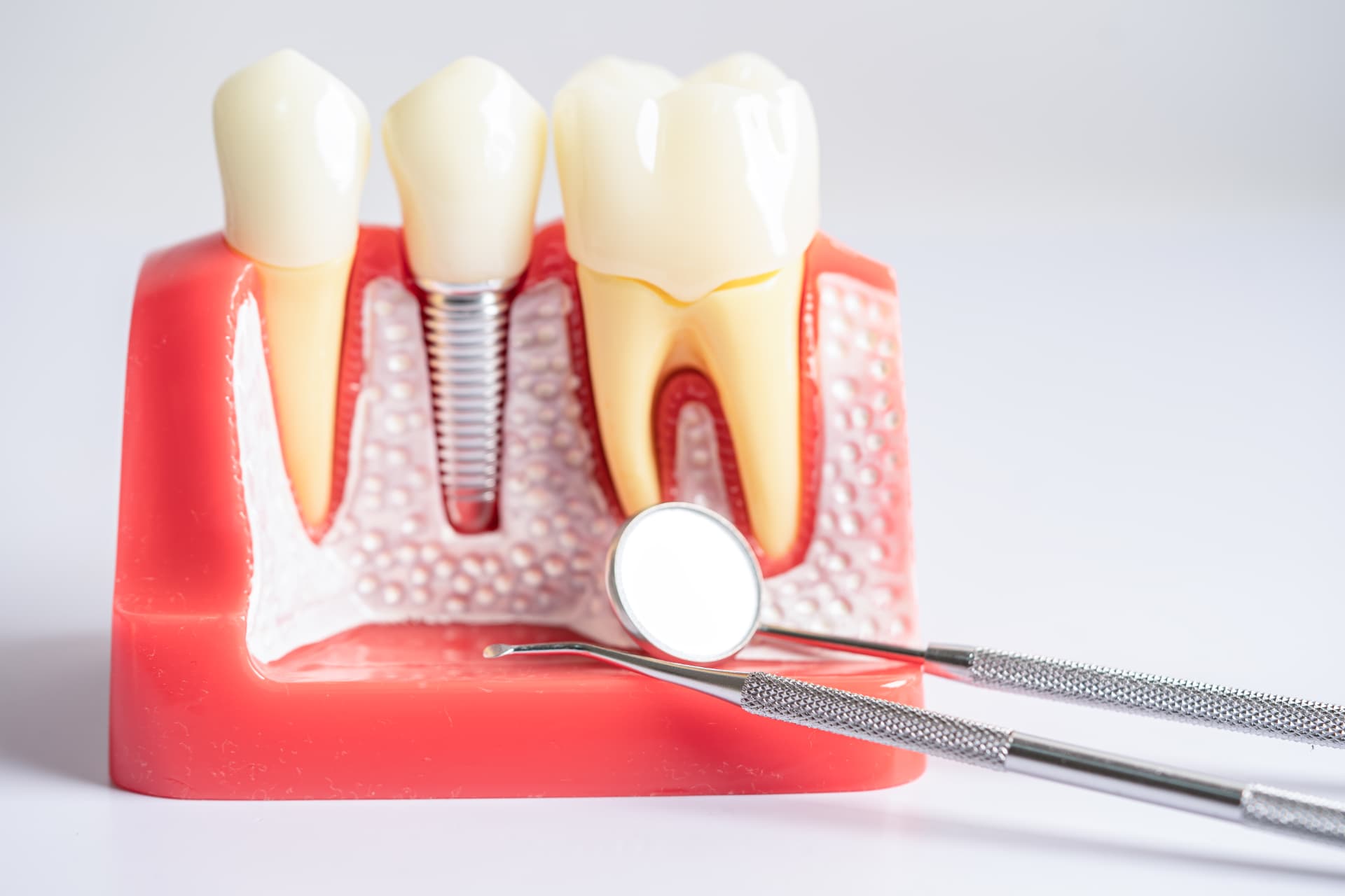 Missing a Back Tooth? Your Replacement Options in Abu Dhabi
