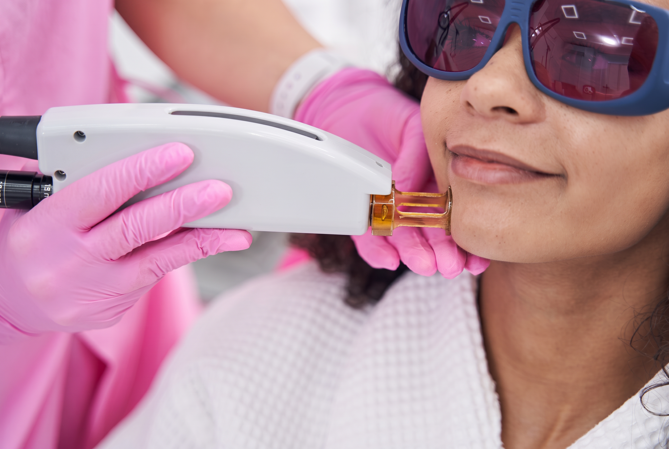Laser hair removal treatment pictured on SmileRite's dermatology page