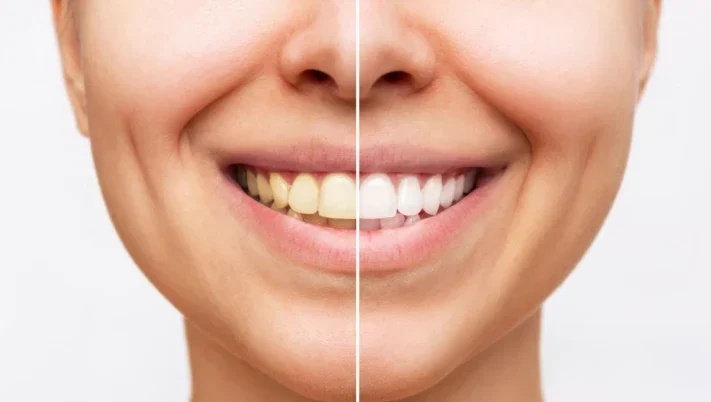 Before and after teeth whitening, showing a split view of a girl's teeth with one side whitened and the other side unwhitened.